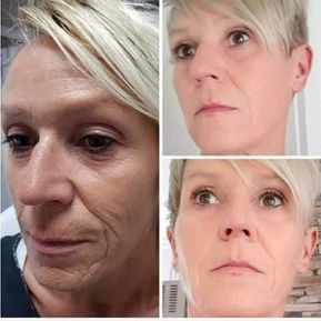 JM Derma Kosmetik_Fadenlifting ohne Nadeln