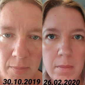 JM Derma Kosmetik_Fadenlifting ohne Nadeln