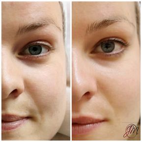 JM Derma Kosmetik_Microdermabrassion_Microneedling