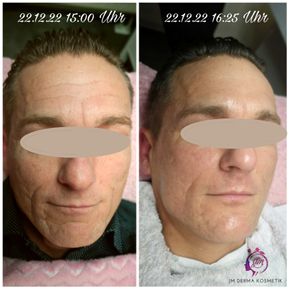 JM Derma Kosmetik_Fadenlifting ohne Nadeln
