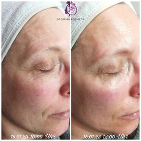 JM Derma Kosmetik_Fadenlifting ohne Nadeln