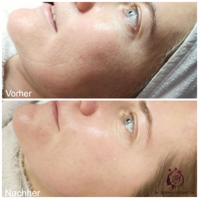 JM Derma Kosmetik_Microdermabrassion_Microneedling