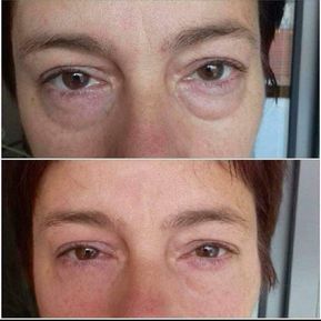JM Derma Kosmetik_Fadenlifting ohne Nadeln