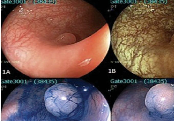 Detección temprana y eficaz del Cáncer de Colon: Buscar pólipos y extraerlos.