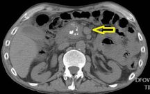 Pancreatite cronica calcifica (freccia gialla)