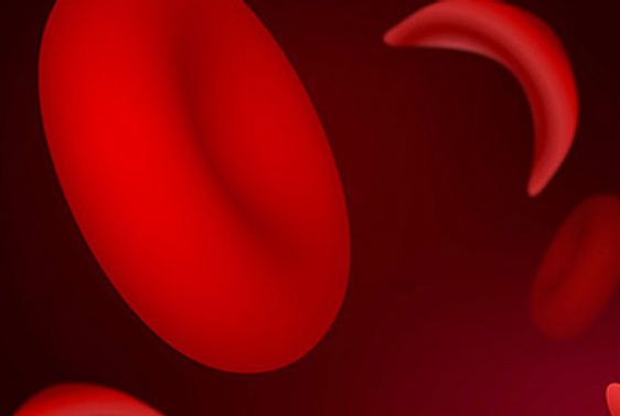 Normal and Sickled Red Blood Cells