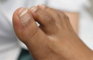 Onyfix nagelkorrigering