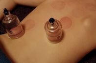 cupping-3310182_1920