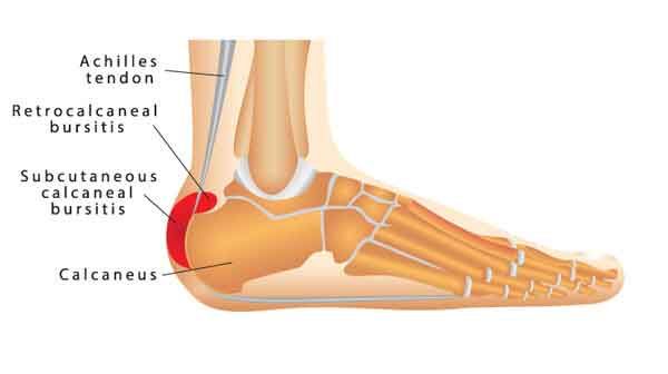 BURSITE RETROCALCANEANA
