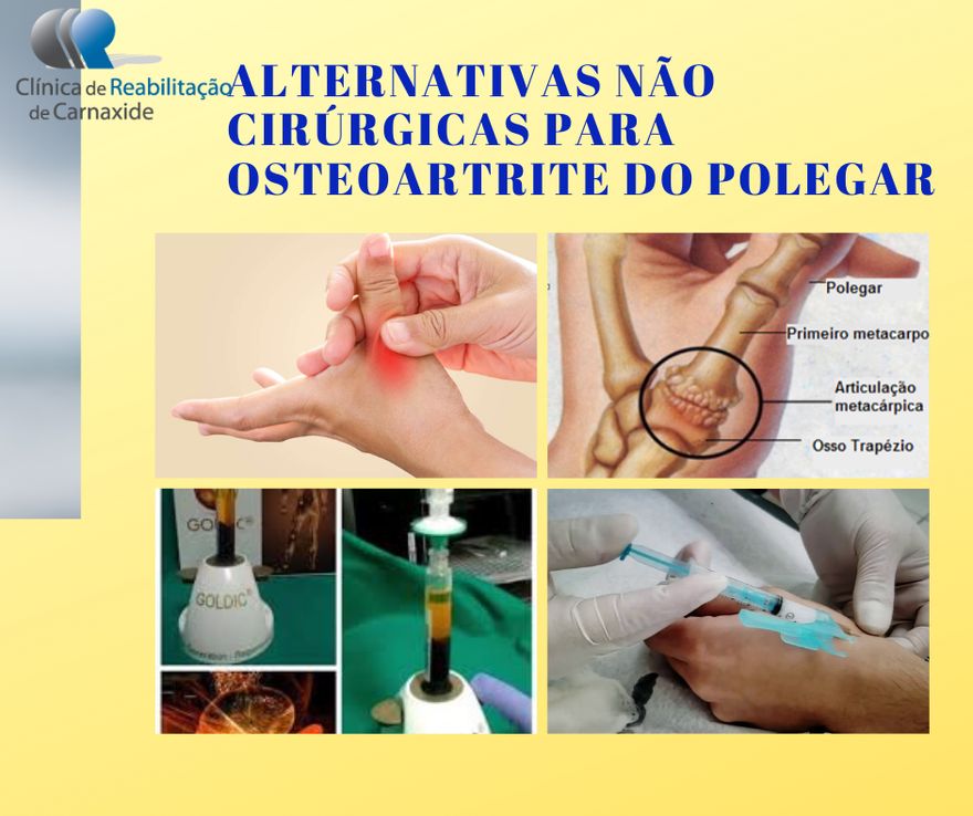Injecção de PRP para artrite basilar do polegar (articulação CMC)