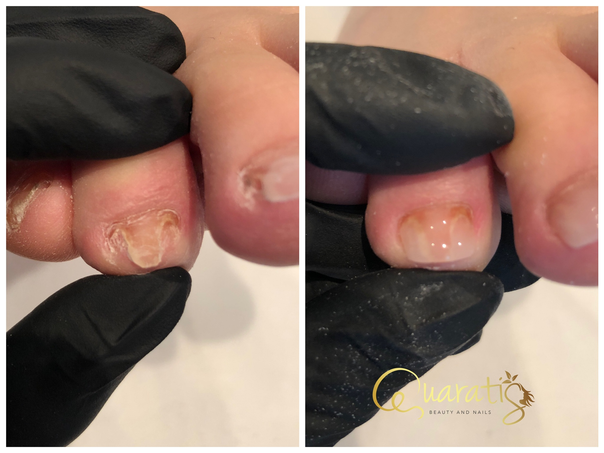 Nagelreconstructie