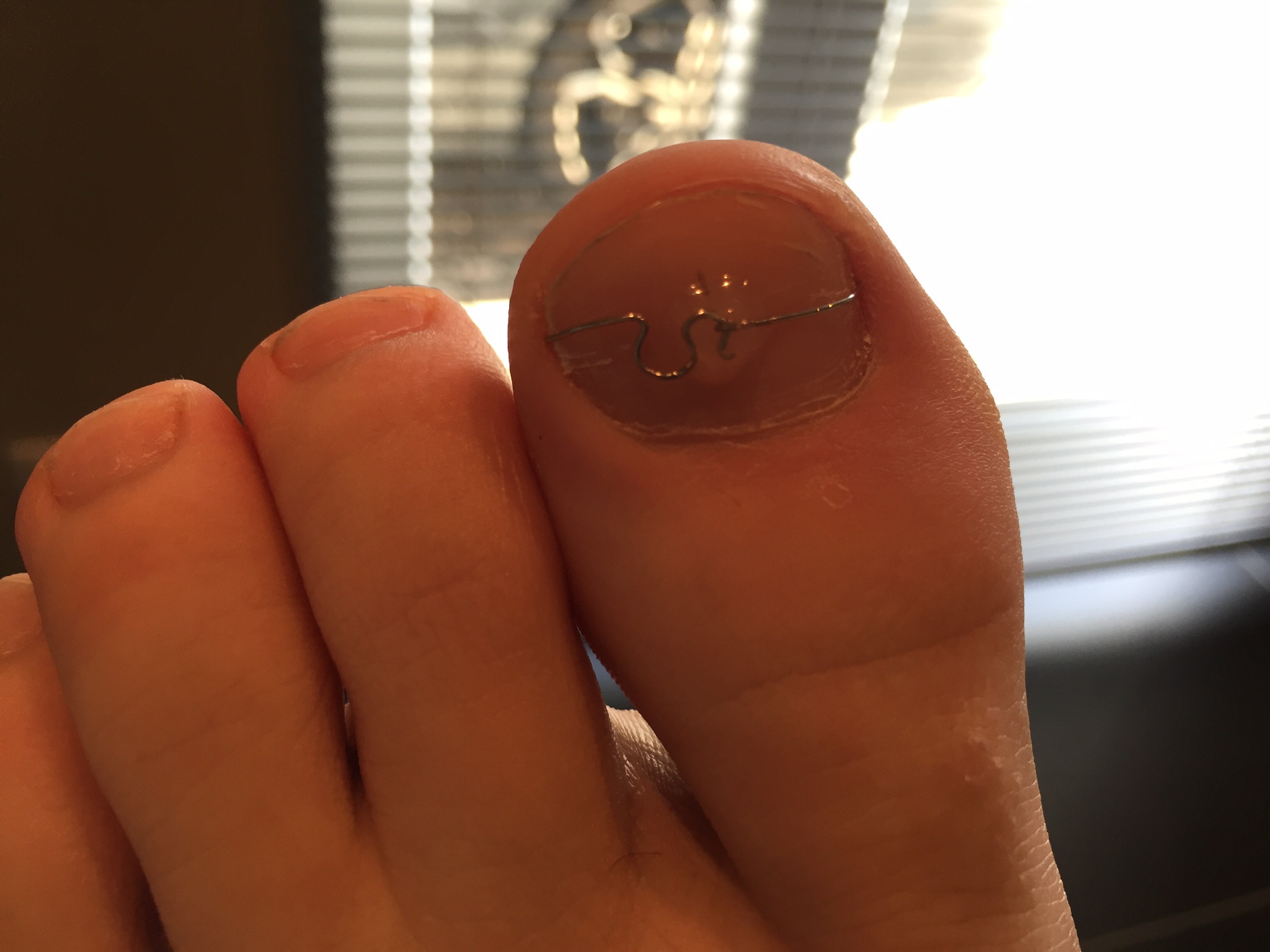 Nagelbeugel Ora 