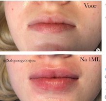 Lipfillers onder en boven