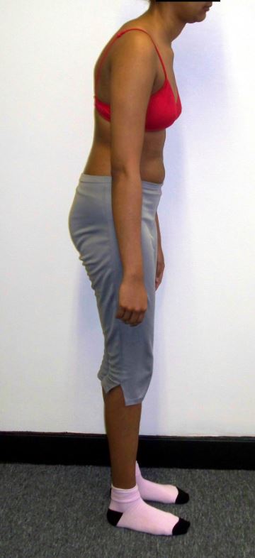 Ankylosing spondylitis (AS) posture, (AS) usually develop slowly over several months or years