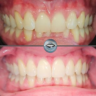 Invisalign and whitening