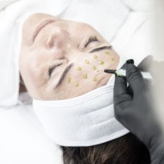 PEELING BEHANDLUNGEN