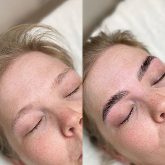 BROWLIFT