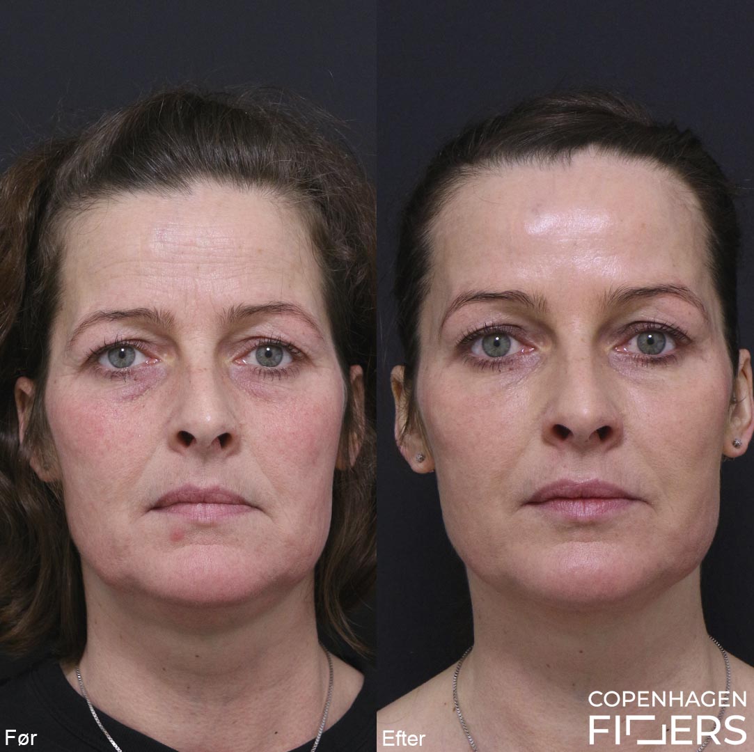 200-kvinde-makeover-restylane-kindben-laeber-mundvige-botox-pande-foer
