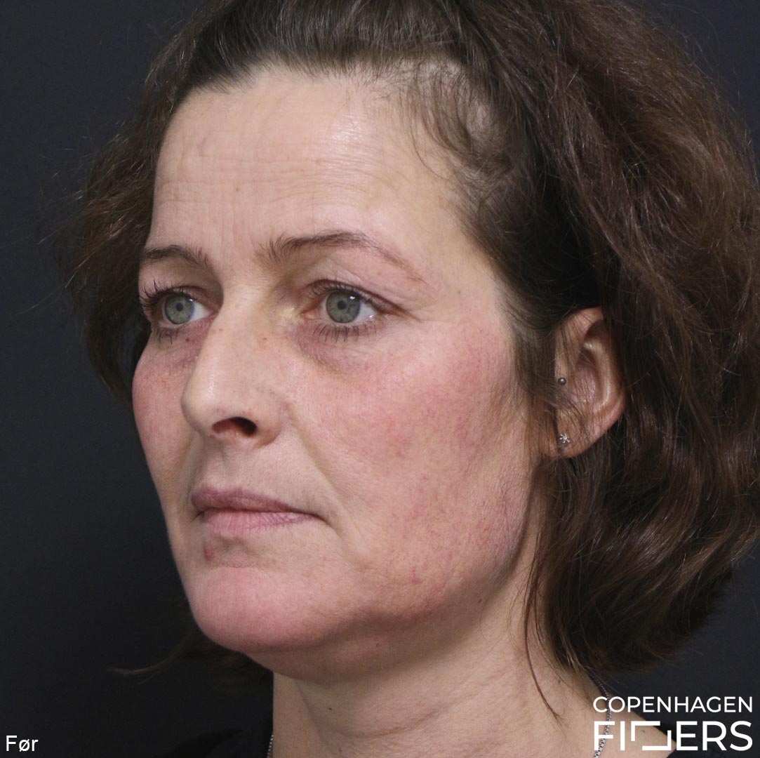 Kvinde restylanemakeover med kindben, læber og azzalure