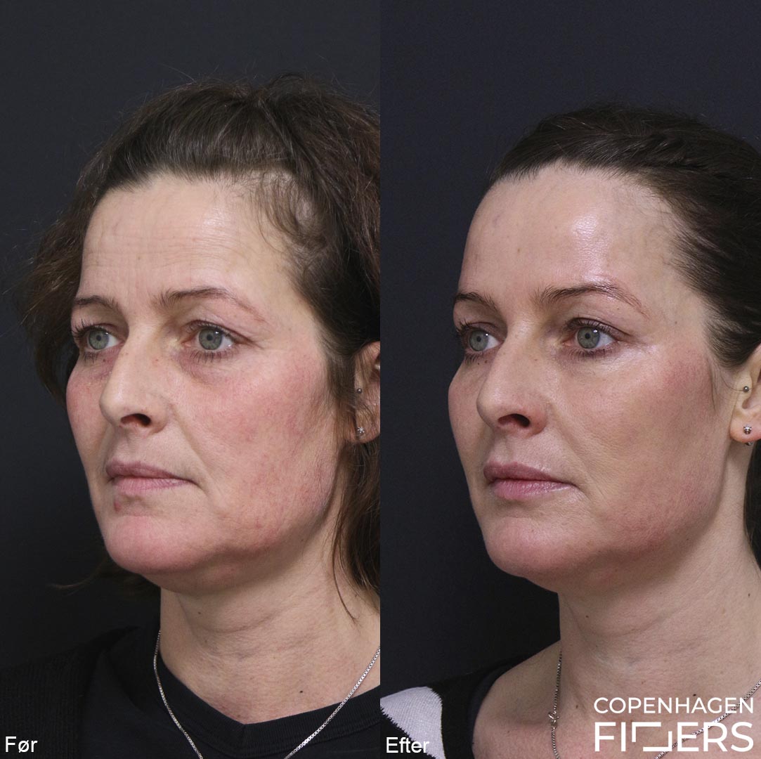 200-kvinde-makeover-restylane-kindben-laeber-mundvige-botox-panderesty