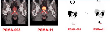PSMA-093: lower Bladder activity 低膀胱摄取、快速显像 （Phase II）