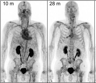 Ga-68 labeled P15-041 ligand for bone imaging