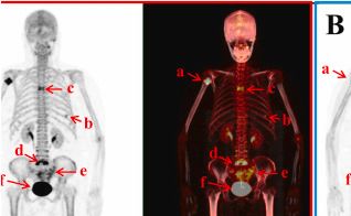 Ga-68 labeled P15-041 ligand for bone imaging: 68Ga-P15-041; 高骨摄取与[18F]NaF相当 （Phase II）